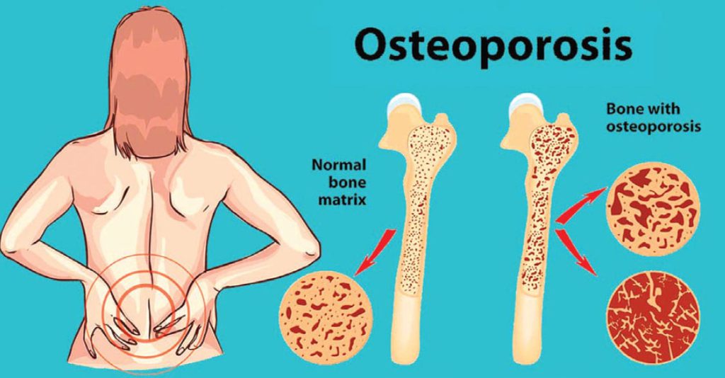 Osteoporosis The Problems of Fragile Bones Hua Hin Today English